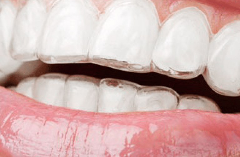 Ortodontia Invisivel - Get Smile